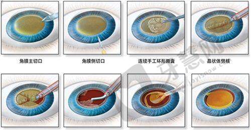 北京同仁医院眼科近视手术价格表避坑指南(血泪经验)