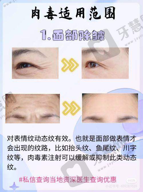 延世大李东勋团队断骨增高手术原理