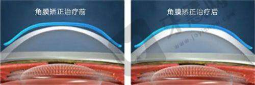 北京大学深圳医院眼科近视手术价格表【2025最新】：全飞秒1.8W|半飞秒1.2W起（附费用明细）