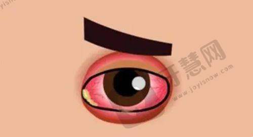 云南大学附属医院眼科近视手术价格影响因素
