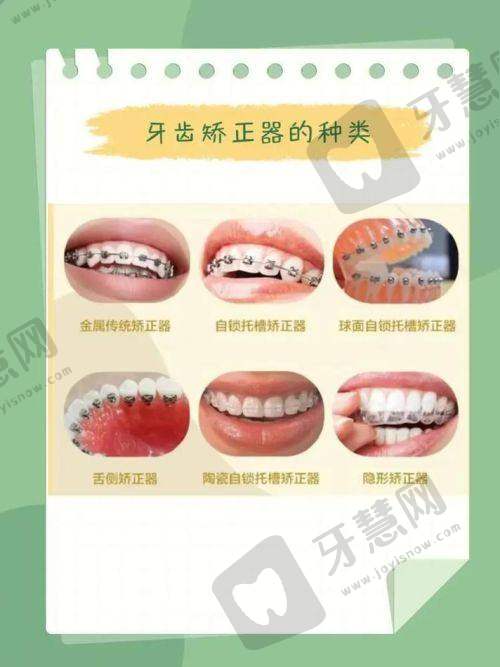 二、何艳医生牙齿矫正手术费用详情