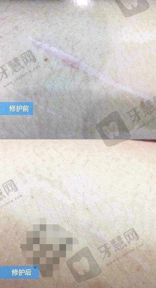 深圳悦尔医疗美容疤痕科地址在哪?预约方式+到院流程:提前1天约,社恐姐妹也不怕!