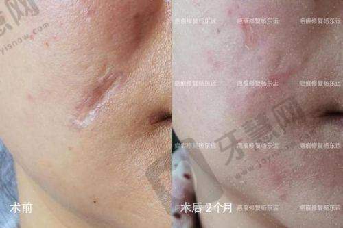 深圳悦尔医疗美容疤痕科地址在哪?2025疤痕修复价格表曝光:1500元起,学生党/宝妈都能负担!
