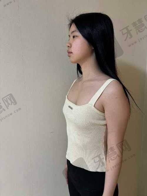沈阳杏林整形医院项目价格表更新：拉皮3万起，50岁阿姨做完像35？SMAS筋膜层提拉是关键！
