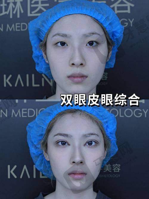 歌莉兰紧缩针说明书公开之治疗成效及维持时间探究