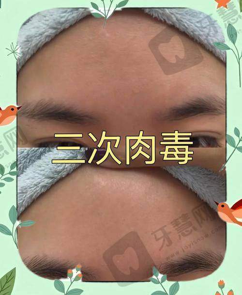 额头川字纹怎么消除的靠谱治疗方法之埋线提升手术