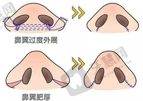 郑州脂肪填充有名的整形医生排名揭秘——脂肪隆胸医生