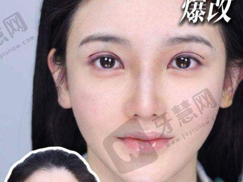 上海杜园园修复双眼皮效果、价格、口碑速览，她在上海爱尚丽格坐诊