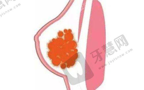 奥美定取出避坑指南：这些“坑”90%的人都踩过！
