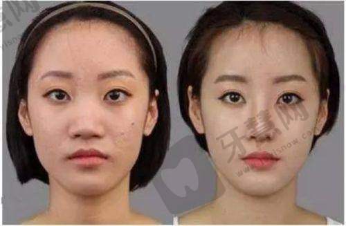 隆胸老了以后怎么办