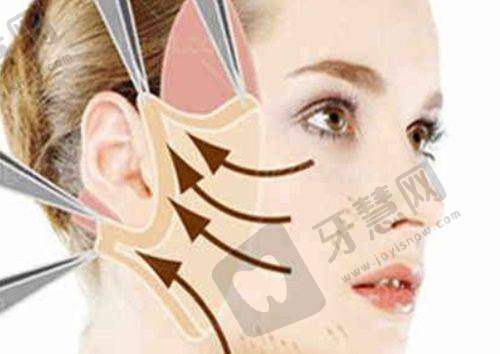 福州莳肌医疗美容诊所电波拉皮去眼袋体验分享