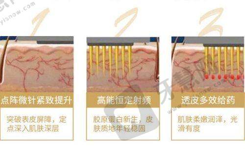 福州莳肌医疗美容诊所黄金微针项目成效