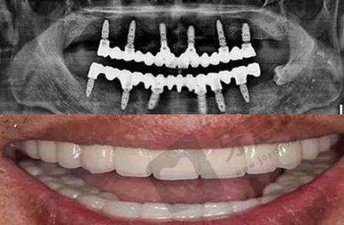 什么是咬合重建的注意事项