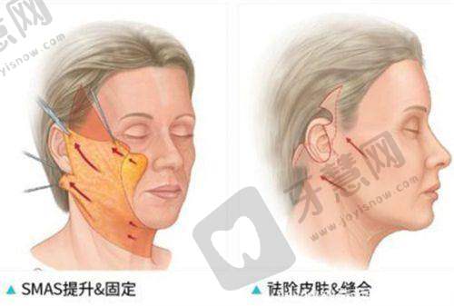 卢元刚医生做筋膜提升是真的好!真实评价反馈:个性化定制,满足需求