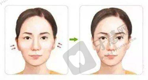 张恒术医生做双眼皮蛮不错的:真人实例超惊艳