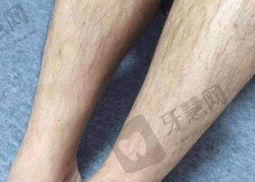 福州莳肌医疗美容诊所的热拉提抗衰特色亮点