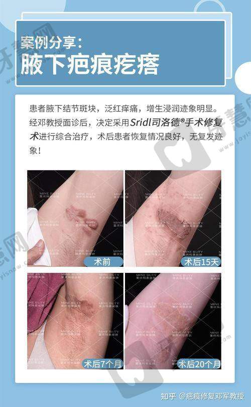 福州莳肌医疗美容诊所黄金微针项目深度剖析