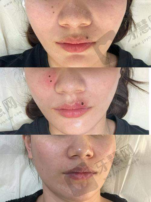 福州莳肌医疗美容诊所水光注射项目体验