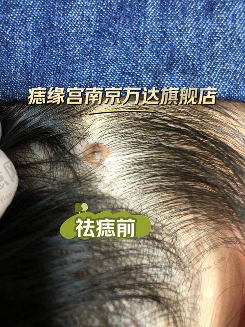 福州莳肌医疗美容诊所双眼近视矫正项目成果