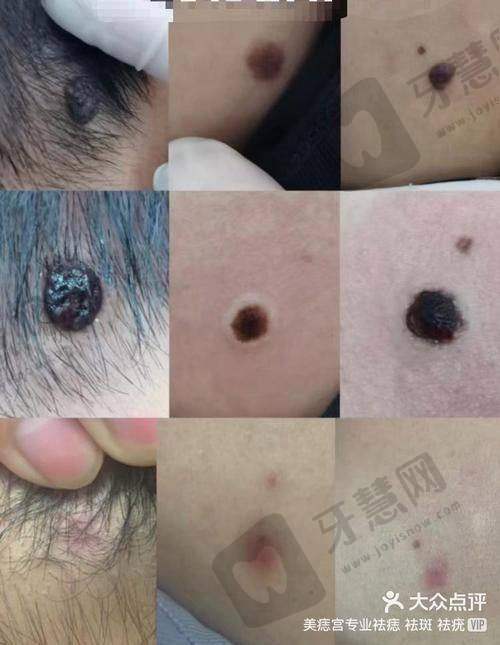福州莳肌医疗美容诊所热拉提抗衰项目优势