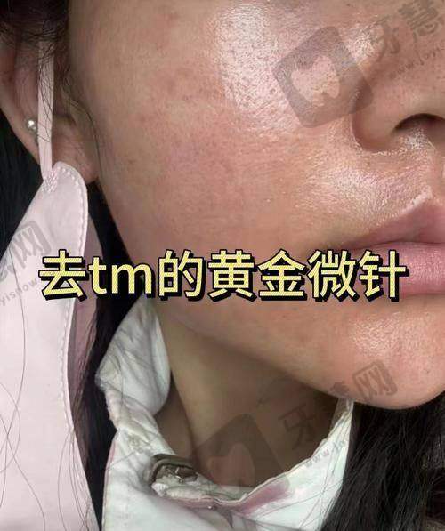 福州莳肌医疗美容诊所电波拉皮去眼袋项目成效