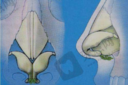 美莱医院开展八爪鱼紧缩术成绩斐然