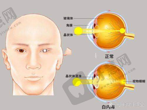 济南正大光明眼科医院真人口碑评价怎么样？