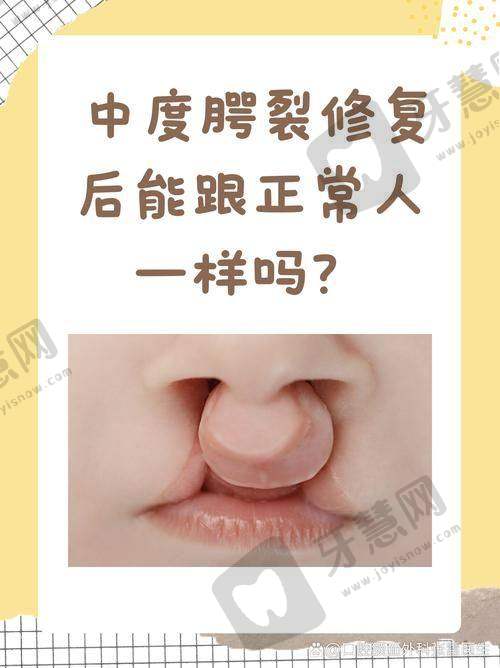 唇裂修复的至佳时机和注意事项