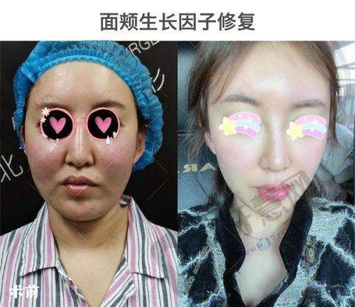 超声炮十天后对比照片:后续成效更值得期待