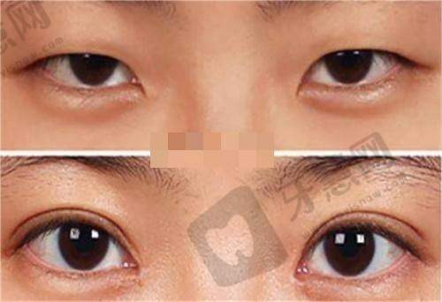 眼袋是什么原因引起的？医生揭秘5大形成因素及2025最新消除妙招