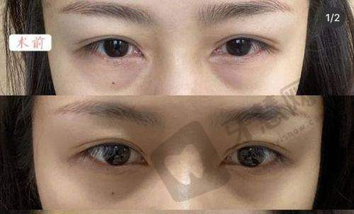 眼袋手术大概多少钱?避坑指南:这3笔钱别白花