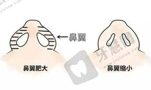 三、2025年真人实例:从“没睡醒”到“睁眼有神”,8毫米双眼皮的100天蜕变记录