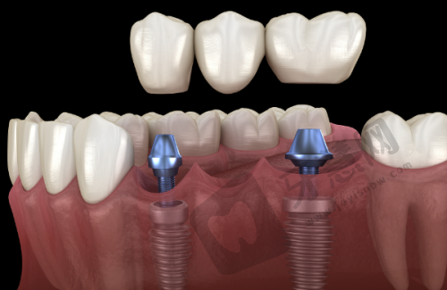 沈阳全好口腔适合哪些人群?5类人千万别错过