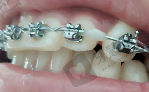 余姚哪家医院看牙齿好?10家口碑好价格实在的牙科推荐