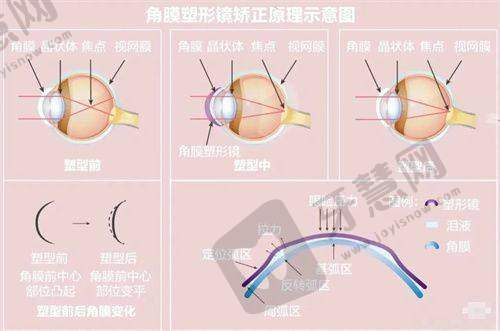 宁波光明爱尔眼科医院专家挂号，附预约攻略及热门专家就诊时间