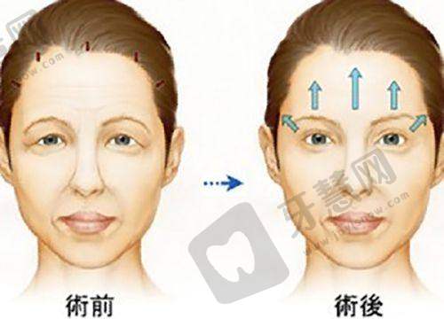 睑缘切口双眼皮优劣之优势解析:这4大“王炸卖点”,让它成了“妈生眼”代名词!