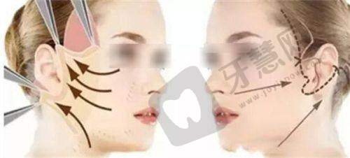 范荣杰鼻修复:患者口碑与满意度