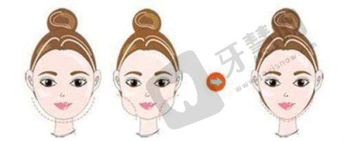 超声炮多久有效果？多数人一月左右渐显成效，祛法令纹10天可见