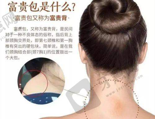 三、多层双眼皮的医美选择:要“福气褶”还是“精致眼”?