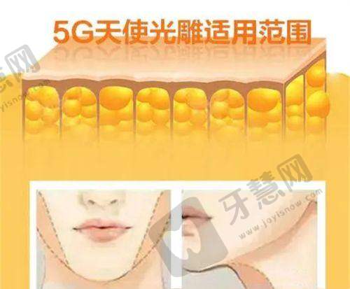 脸缘切口双眼皮优劣大揭秘:恢复快不留疤?2025年最全解析来了!