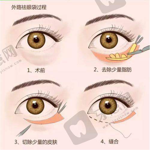 脸缘切口双眼皮是埋线吗?揭秘8种双眼皮失败症状及修复方法,看完再决定!