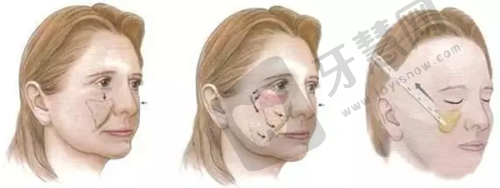 3. 重度眼袋(脂肪膨出 + 皮肤松弛 + 泪沟):2025年“眶隔脂肪释放术”成主流,一举两得