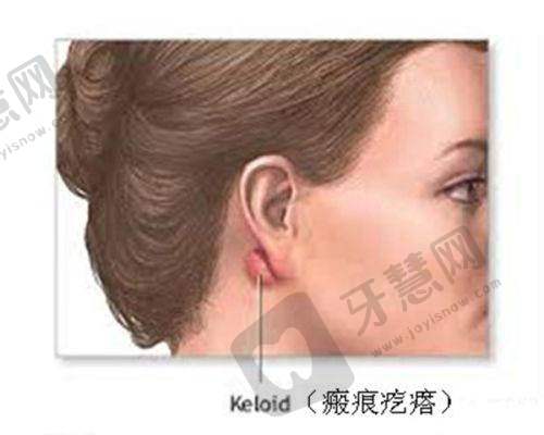 睑缘切口双眼皮优劣之劣势预警:这5大“雷区”,90%的人术前不知道!