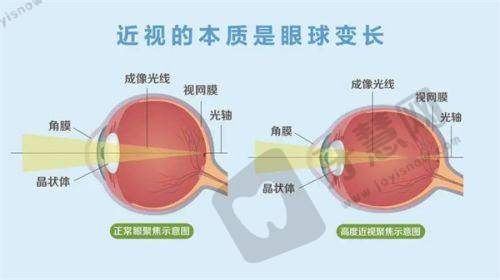 昆明眼科医院圆锥角膜交联手术费用详解