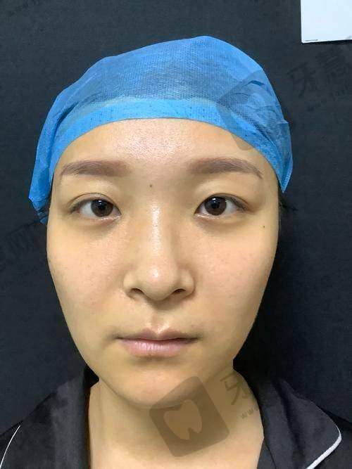 修复双眼皮和第一次割双眼皮一样吗?成效预期要清醒:初眼求“惊艳”,修复求“自然+功能”
