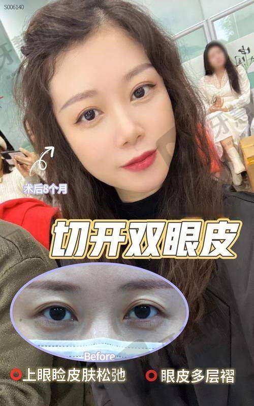 脸缘切口双眼皮多少钱2025?专业医生解析价格差异+全国热门医院对比