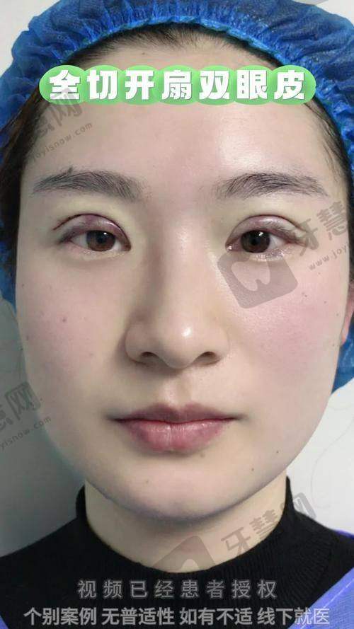 睑缘切口双眼皮是恒久的吗?35岁以上做要注意什么