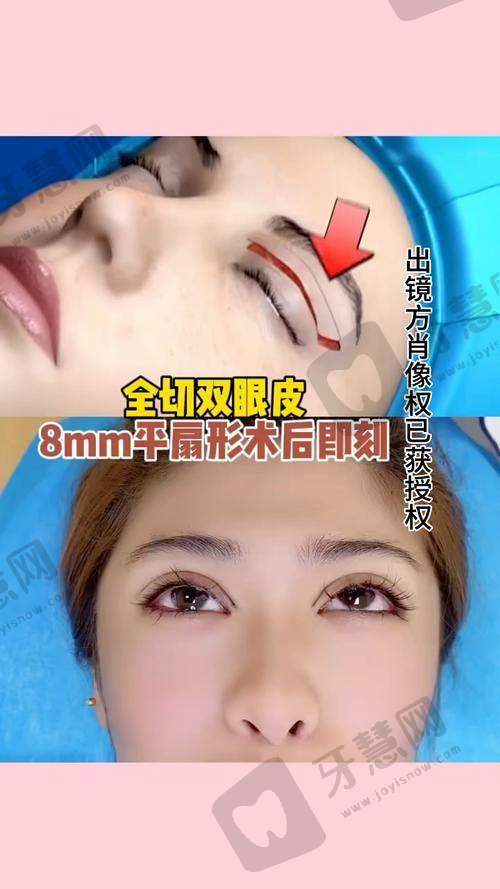 辽宁曙光整形医院电话号码问医生:白迪医生双眼皮技术亮点+真人实例反馈