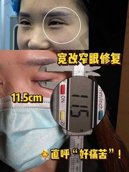肿泡眼割双眼皮恢复很慢吗？90天真实恢复过程大公开，消肿秘诀全在这！