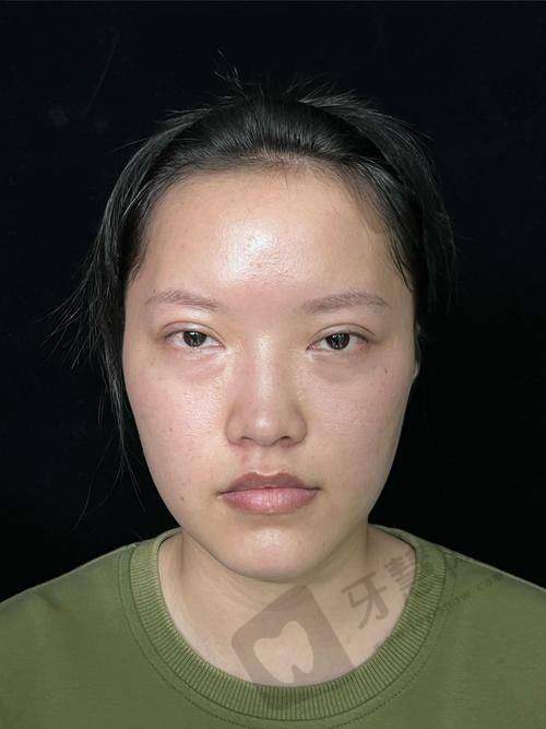 方案2：双眼皮形态修复术——针对“一宽一窄”“一双一单”的不对称